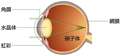 白内障