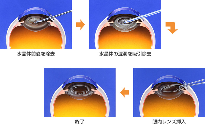 白内障手術について